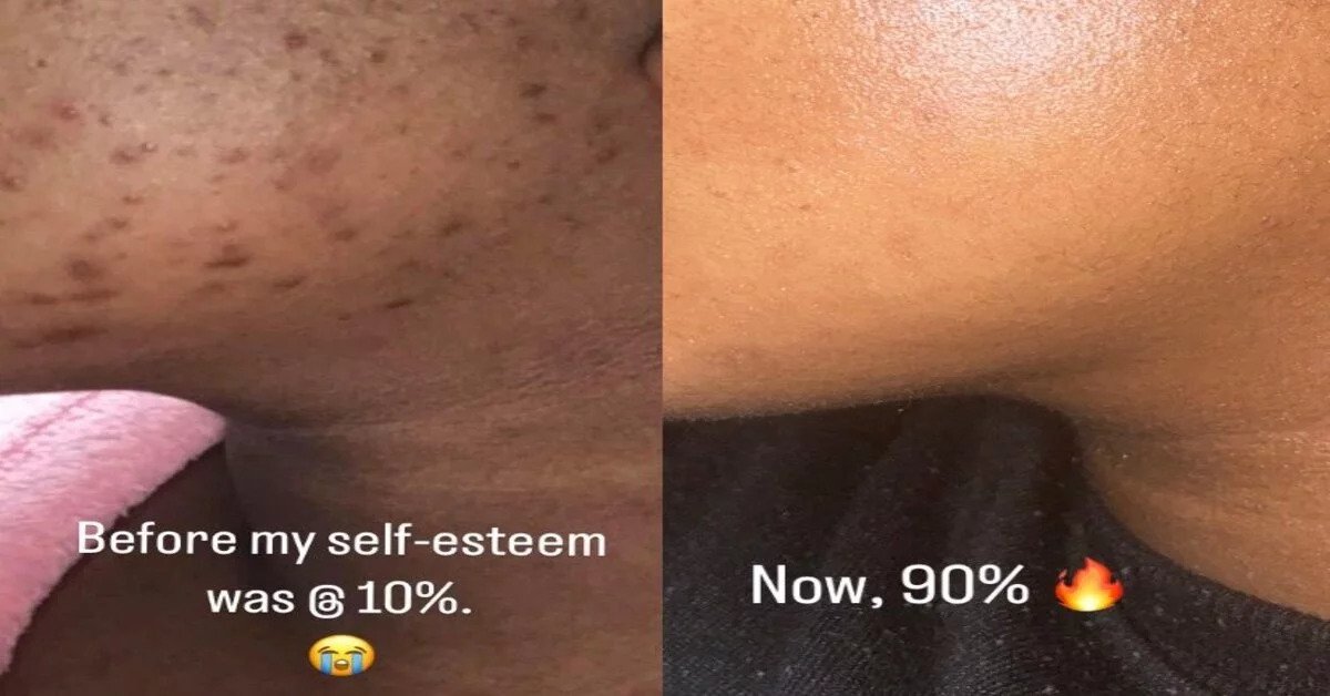 Woman Shares Her Skin-Care Journey And Tips On How To Achieve A Flawless Skin