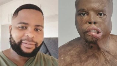 PICS | Tongaat Man Fights for Justice After Acid Attack by Girlfriend